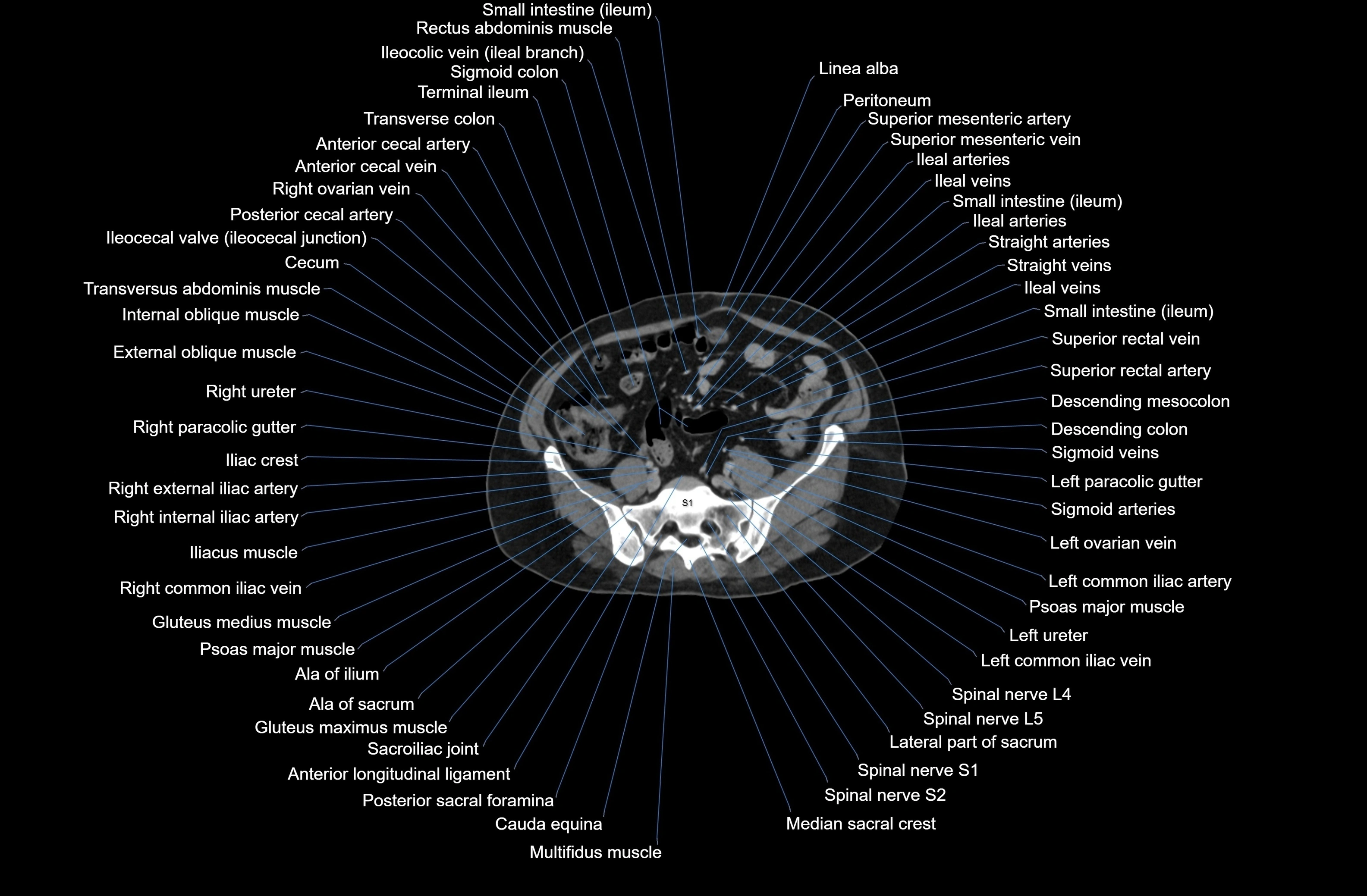 CT Abdomen axial cross sectional anatomy labelled radiology image-00066.webp